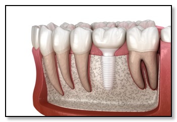 all ceramic dental implant in bone crossection