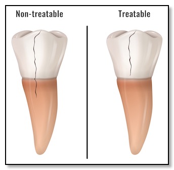 cracked tooth treatable if not below gum line