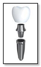 dental implant image.