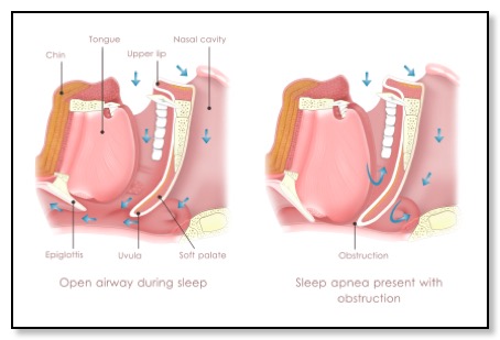 Airway blockage causes snoring and sleep apnea example cross section of throat