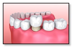 Dental Crown Being Placed Diagram