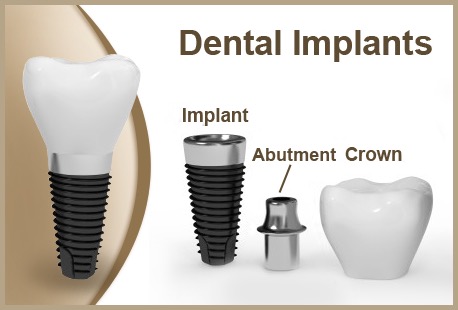 dental-Implant